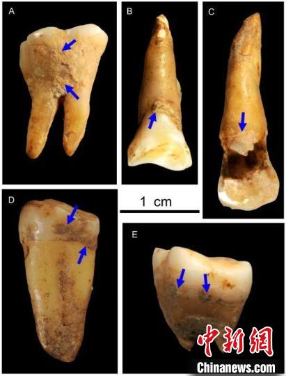 湖南道縣福巖洞8-12萬(wàn)年前古人類的牙結(jié)石?！清?供圖